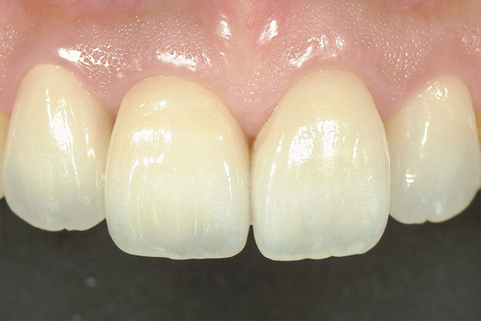 オールセラミックス