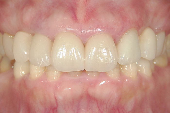 歯茎が綺麗