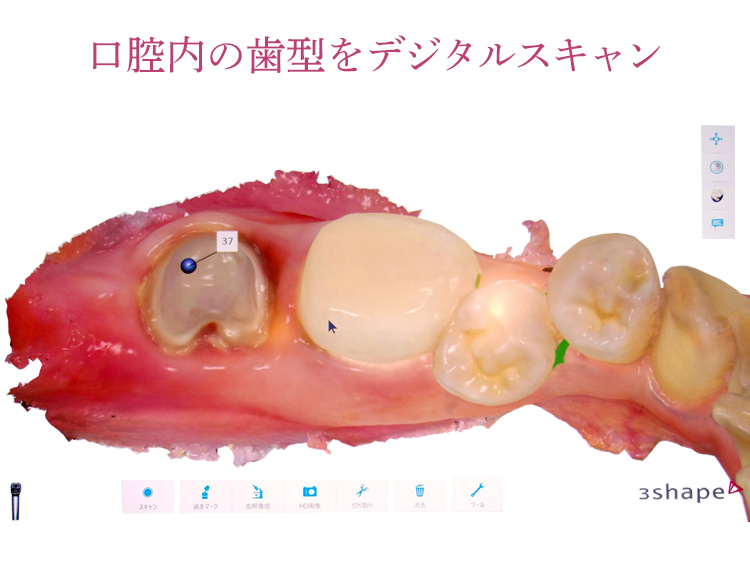 口腔内の歯型をデジタルスキャン