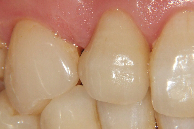 歯 と 歯 の 間 黒い 痛く ない