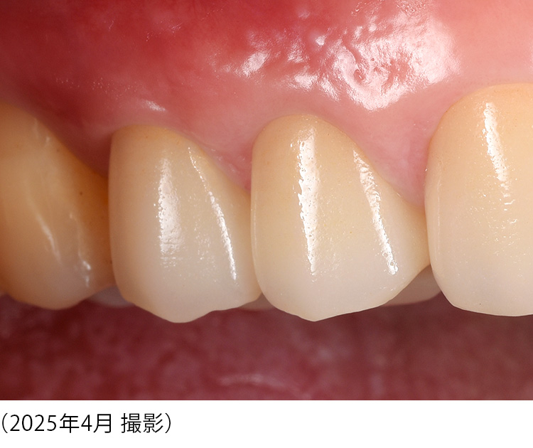 ４年後