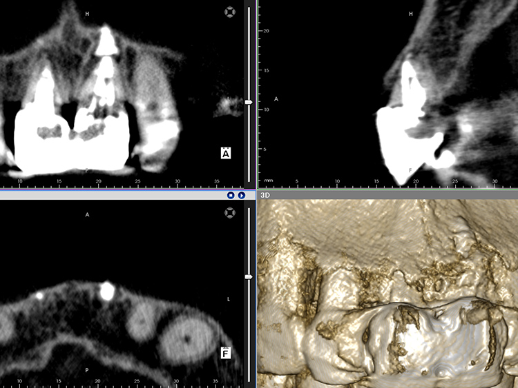治療後のレントゲン