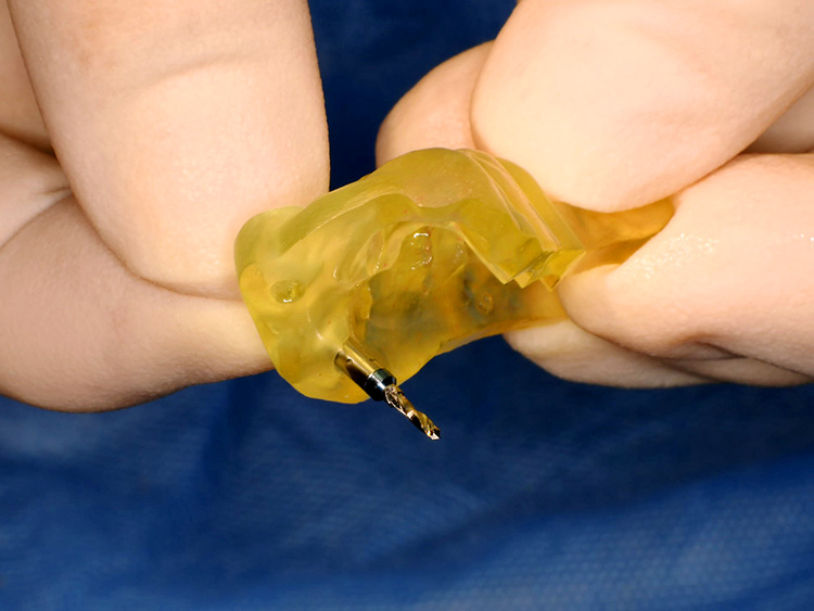 サージカルガイド