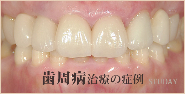 歯周病治療の症例