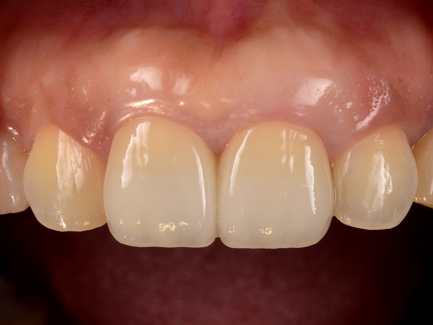 審美治療の治療写真