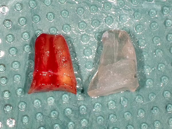 自家歯牙移植術