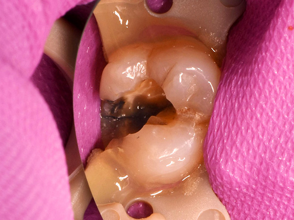 銀歯の中が虫歯
