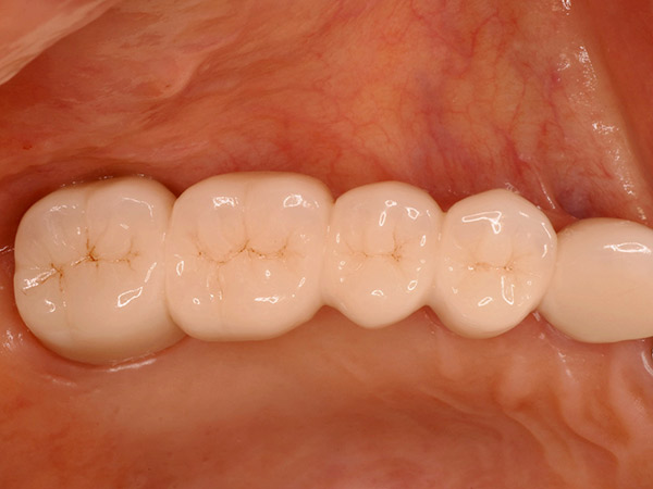 奥歯のセラミック