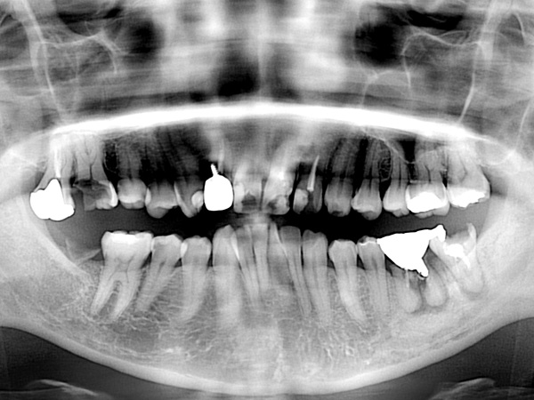 治療前のレントゲン