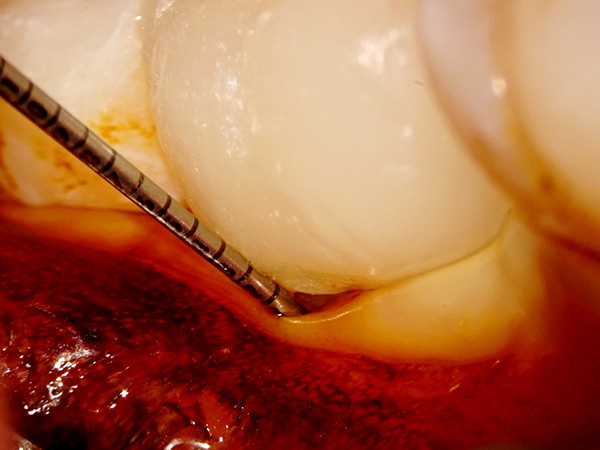 根分岐部歯周組織のシーリング