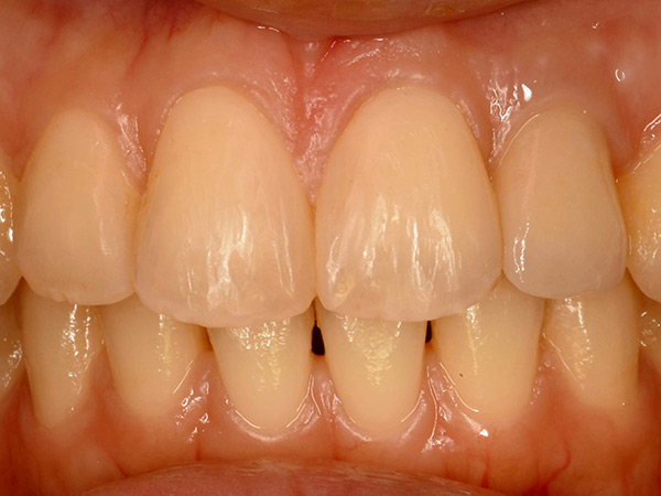 前歯の修復