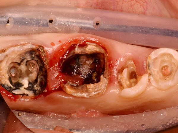 歯の根の治療