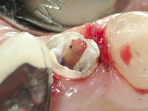 末期的な歯