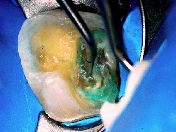 虫歯の中の治療