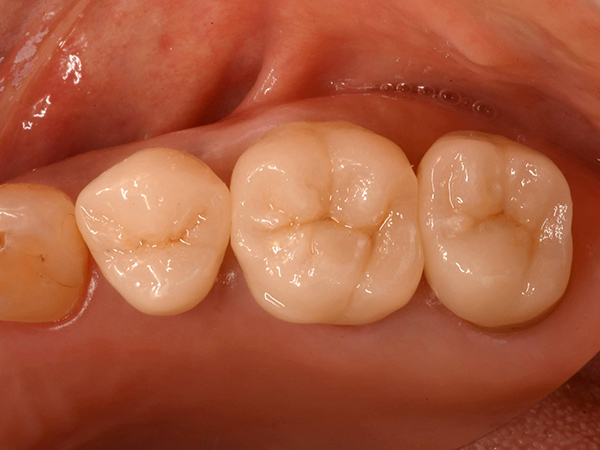 奥歯のセラミック