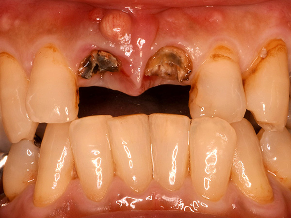 2つの前歯のない